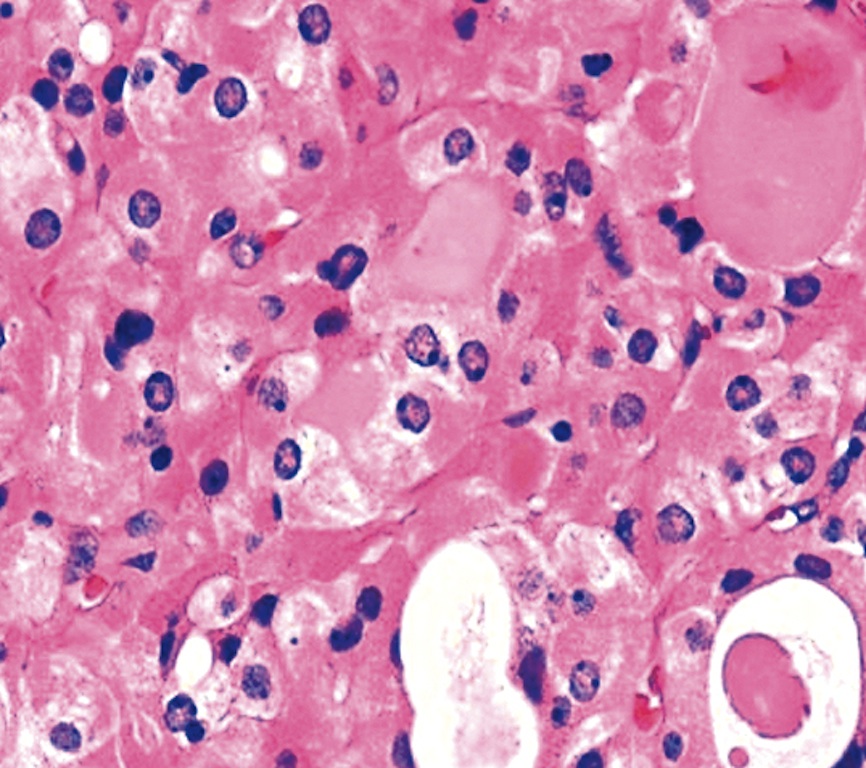 Pathology Outlines Oncocytic (Hürthle cell) tumors